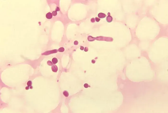 A skin fungus turns out to be an ally